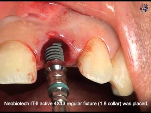 Immediate Placement Immediate Loading in the Maxillary Central