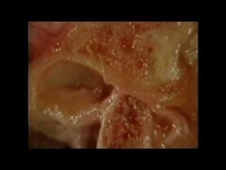 TMJ non-reducing disc displacement