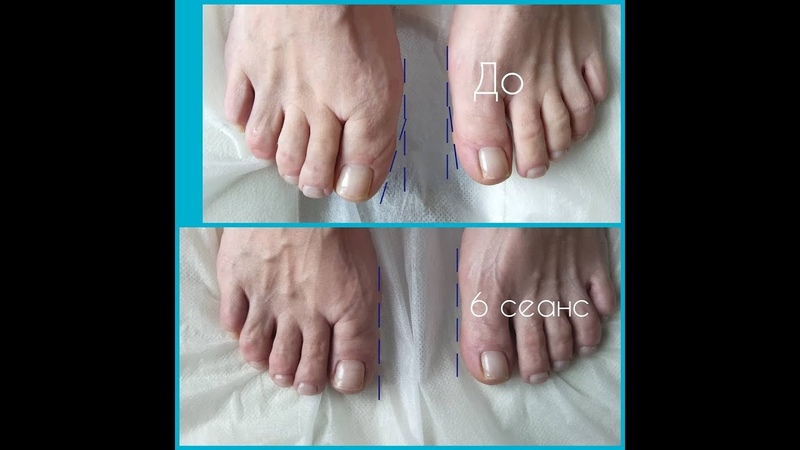 деформация стопы видео. эквиноварусная деформация стоп. деформация стопы видео. плоскостопие 2-3 степени вальгус. халюс вальгусная деформация стопы.